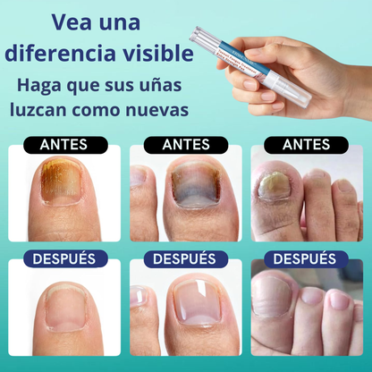 Lápiz Antihongos Extra Fuerte 25% Ácido Undecilénico